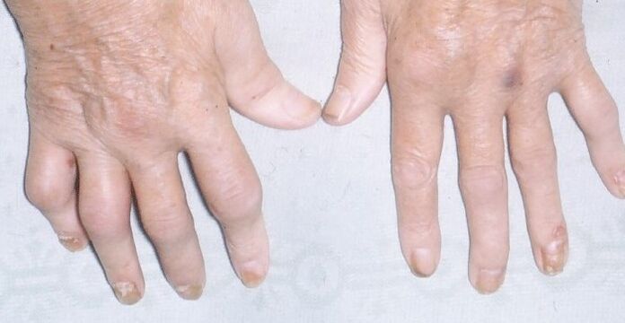 artropatická psoriáza na rukách