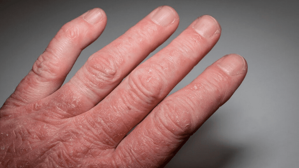 psoriatická artritída na rukách