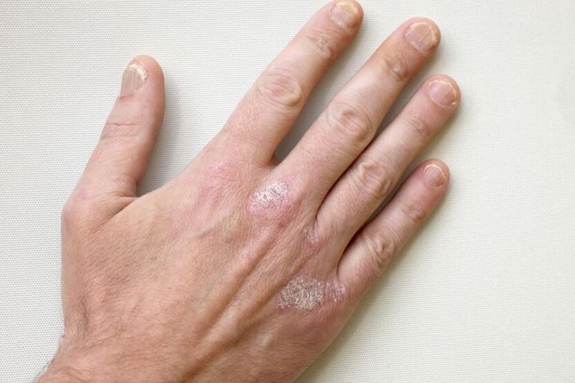Povinným príznakom psoriázy sú plaky so šupinami na koži