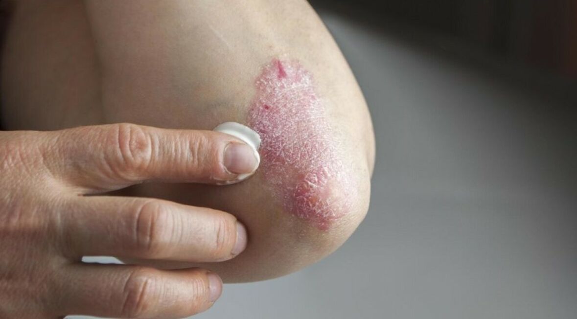 Psoriáza postihujúca kožu, ktorej liečba zahŕňa použitie masti