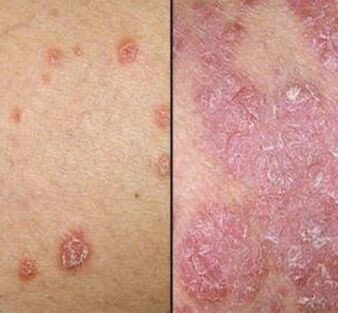 Psoriatické plaky