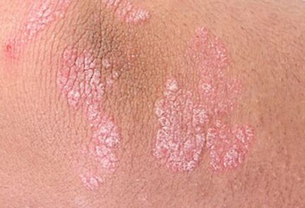 psoriáza