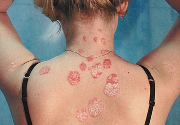 Psoriáza na chrbte