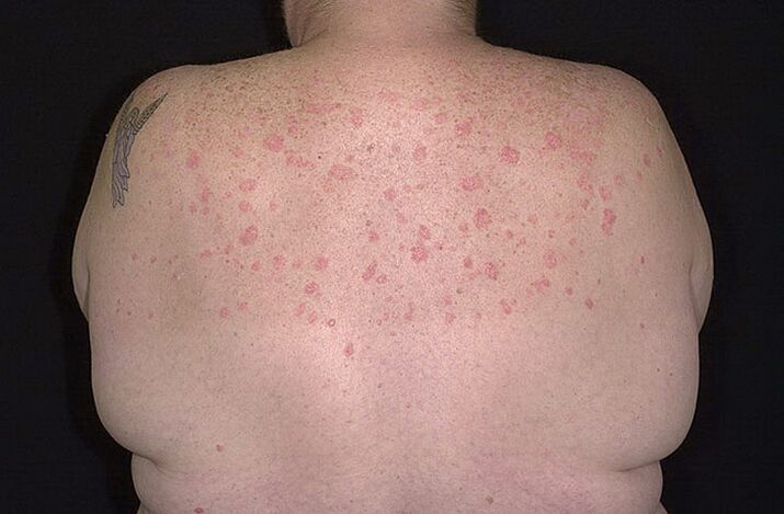 Psoriáza na pleciach