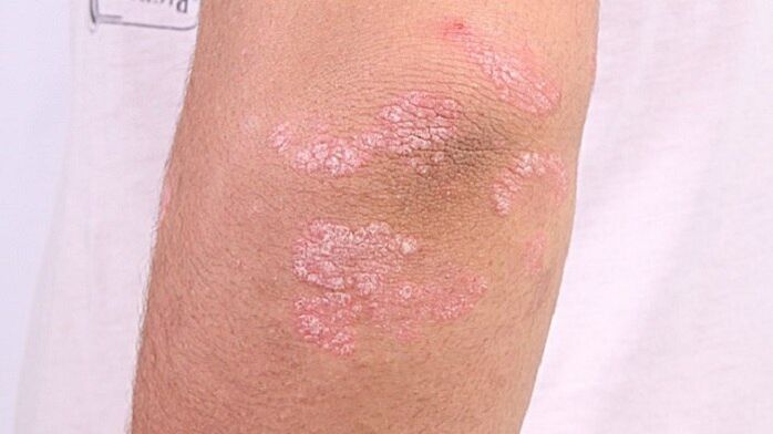 fotografia skorého štádia psoriázy