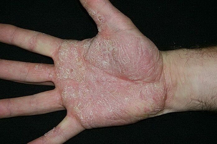 psoriáza dlaní a chodidiel