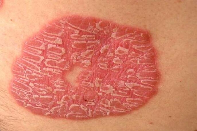 pustulózna psoriáza