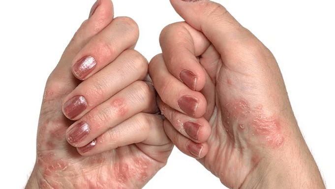 počiatočná fáza psoriázy