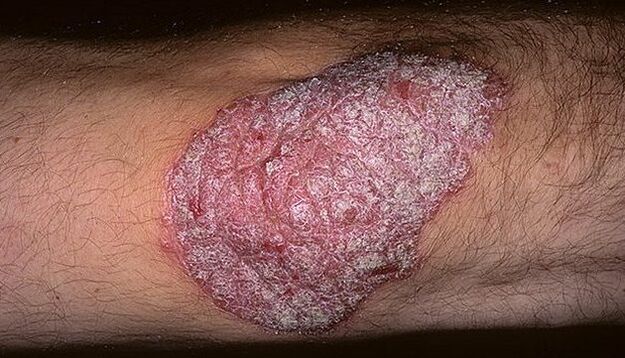 psoriáza